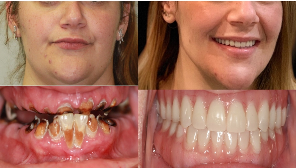 Full Mouth Rehabilitation